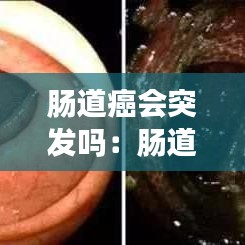 腸道癌會突發(fā)嗎：腸道癌會怎么樣 